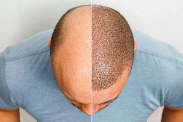 Haartransplantation Gütersloh Nordrhein Westfalen Haartransplantation Gütersloh Nordrhein Westfalen